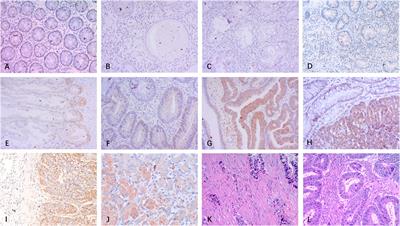 Increasing Embryonic Morphogen Nodal Expression Suggests Malignant Transformation in Colorectal Lesions and as a Potential Marker for CMS4 Subtype of Colorectal Cancer